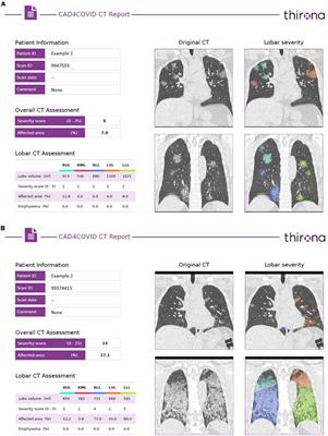 Automatized lung disease quantification in patients with COVID-19 as a predictive tool to assess hospitalization severity
